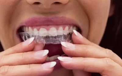 Invisalign Northridge: Clear Aligner Therapy for Discreet Orthodontic Correction